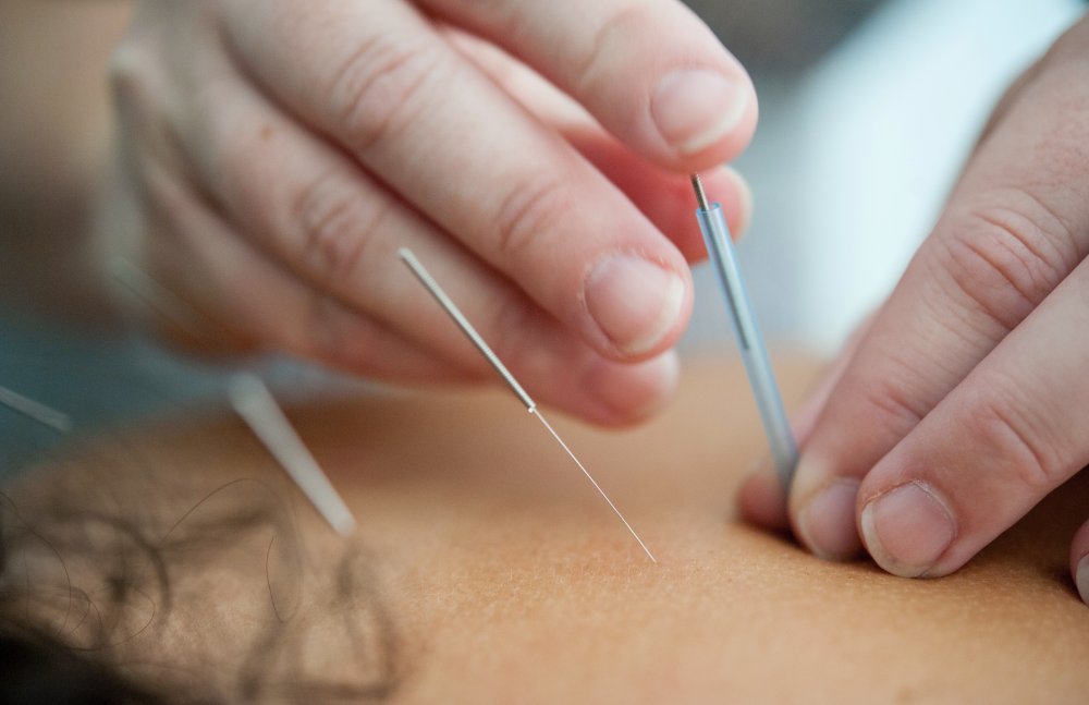 Få lindring for dine smerter med akupunktur